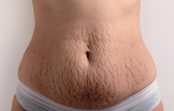 stretch-marks