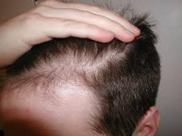 Nofap For Hair Regrowth General Discussion Rewire Companion Forum