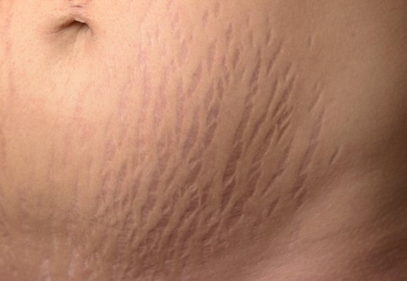 A_0119_stretch_mark_white_skin_abdo_F6XPNA.max-600x600-1